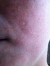 scar looks more white against tanned skin - is indented also.