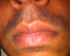 Ingrown hair