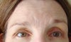 10 days post-op. Knew from day one, though, that there would be a problem because left eye incision was arched, tortuous, puckered, and cut down far too low in the medial can thus.