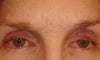 Incision can be seen straight on, no fold, hard time to cover with makeup. Eyelids turn straight up.