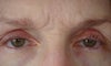 Incision is raised, red, puckered, and tortuous. Can't be hidden because no skin fold. I don't think it can be revised because there is not enough skin to close lid.