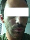 Right side of the face more indentured than the left.