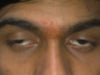 Both eyes