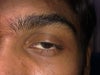 left eye