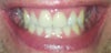 My teeth