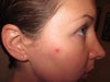 7 days post biopsy
