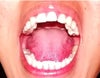 Full mouth