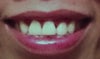 This is my front teeth. It's really making more self-conscious when I see them.