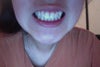 I have a tooth less than normal people in my lower jaw, so the teeth in my upper and lower jaws don't match.