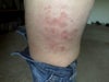 VelaShape bruising on my thigh, (saddle bag area).