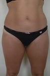 front view pre-op