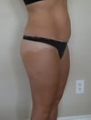 side angle pre-op