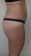 side view pre-op