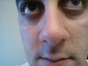 Eye bags