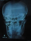 FACIAL IMPLANTS FRONT
