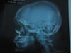 FACIAL IMPLANTS SIDE VIEW