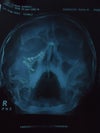 FACIAL IMPLANTS OPENING MOUTH