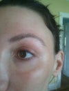 Post Fraxel Dual Treatment: 5 months later
