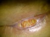 seroma on incision line