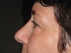 side view - left eye
