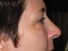 side view - right eye
