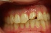 Chipped front teeth