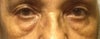 My eye bags seem to have double bags today allergic reaction not sure the larger ones I had all my life. :(