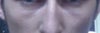 Under eye skin at its worst.