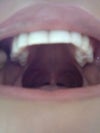 Upper arch