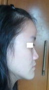 what safe procedure to go for? any cosmetic surgeon in singapore to recommend? i want to look natural after the procedure