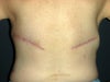 back scars from LD flap, causing severe back pain between scars to present time