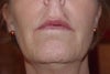 with makeup, lip crooked and swollen looking area above the lip (3 weeks after procedure)