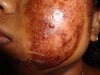 the left side of my face as of august 31, 2012.  i'm on my third day.