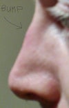 Post-rhinoplasty nasal bridge bump.
