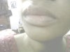 Lip scar 1.