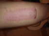 This picture is not mine, but when I had my skin grafts, they looked identical to the one in this picture afterward. Since, the redness has faded, but the skin texture has stayed the same.
