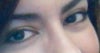smiling- lower eye lid fat