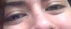visible under eye fat