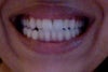 teeth closed