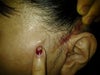 found out a bump near my left ear. My Korean surgeon, Dr. Hwang, told me that suture remained under the bump.
