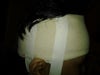 Scar revision on my head (4 areas) due to hair loss caused by 6/19/12 surgery in Mexico.