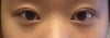 my left eye is noticeably more swollen than my right eye.