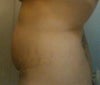 Side view: I want to get rid of the extra fat and stretchmarks.