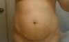 Front view: I want belly button fixed, muscles tighter, pooch gone, and on upper vagina fat gone.