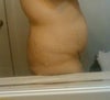 Side View: Again, the love handles, hips, and stretchmarks. As you can see the sagging skin all the way to buttocks with dimply cellulite. Will an extended tummy tuck get rid of all of this?