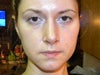 8 weeks post rhino - right nostril looks very different