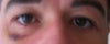 10 days post op.sorry i havent got any up to date ones
my right eye just looks bruised and you cant really see the bag.
Will get new pics up.Thanks