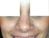 smiling (noticeable bump)