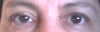 Ptosis right eye