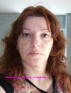 Before surgery
